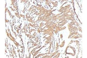 Formalin-fixed, paraffin-embedded human Leiomyosarcoma stained with ACTA2 antibody.
