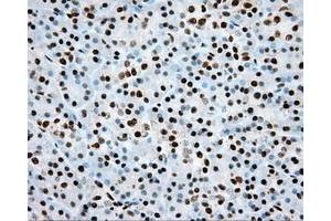 Immunohistochemical staining of paraffin-embedded Adenocarcinoma of colon tissue using anti-ARNT mouse monoclonal antibody. (ARNT anticorps)