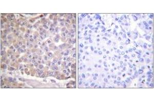Immunohistochemistry analysis of paraffin-embedded human breast carcinoma tissue, using IRS-1 (Ab-1101) Antibody. (IRS1 anticorps  (AA 1067-1116))