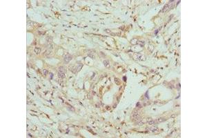 Immunohistochemistry of paraffin-embedded human pancreatic cancer using ABIN7148460 at dilution of 1:100 (COG5 anticorps  (AA 1-260))
