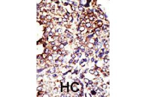 Formalin-fixed and paraffin-embedded human hepatocellular carcinoma tissue reacted with GCNT1 polyclonal antibody  , which was peroxidase-conjugated to the secondary antibody, followed by DAB staining . (GCNT1 anticorps  (Internal Region))