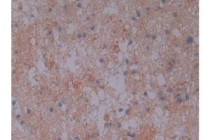 Detection of AMPK Alpha 1 in Human Glioma Tissue using Polyclonal Antibody to Protein Kinase, AMP Activated Alpha 1 (AMPK Alpha 1)