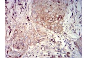 Immunohistochemical analysis of paraffin-embedded lung cancer tissues using CD66A mouse mAb with DAB staining.