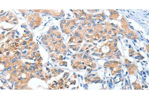 Immunohistochemistry of paraffin-embedded Human lung cancer using AUP1 Polyclonal Antibody at dilution of 1:50