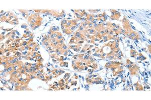 Immunohistochemistry of paraffin-embedded Human lung cancer using AUP1 Polyclonal Antibody at dilution of 1:50 (Ancient Ubiquitous Protein 1 anticorps)