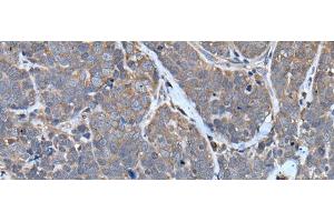 Immunohistochemistry of paraffin-embedded Human thyroid cancer tissue using TNMD Polyclonal Antibody at dilution of 1:40(x200) (TNMD anticorps)