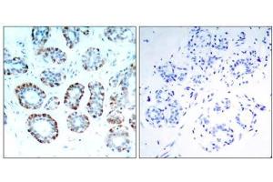 Immunohistochemical analysis of paraffin-embedded human breast carcinoma tissue, using BIM (Ab-65) antibody (E021280). (BIM anticorps)