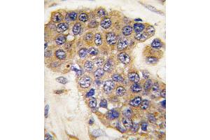 Formalin-fixed and paraffin-embedded human breast carcinoma tissue reacted with Puma BH3 Domain antibody (ABIN388112 and ABIN2846254) , which was peroxidase-conjugated to the secondary antibody, followed by DAB staining.