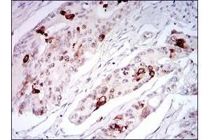 Immunohistochemical analysis of paraffin-embedded rectum cancer tissues using TERF2 mouse mAb with DAB staining.
