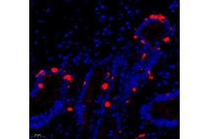 Immunofluorescence of paraffin embedded human gastric cancer using DCR3 (ABIN7076071) at dilution of 1: 700 (400x lens) (TNFRSF6B anticorps)