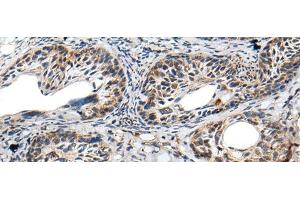 Immunohistochemistry of paraffin-embedded Human cervical cancer tissue using PRNP Polyclonal Antibody at dilution of 1:45(x200) (PRNP anticorps)