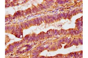 IHC image of ABIN7162317 diluted at 1:400 and staining in paraffin-embedded human colon cancer performed on a Leica BondTM system. (Osteomodulin anticorps  (AA 339-411))