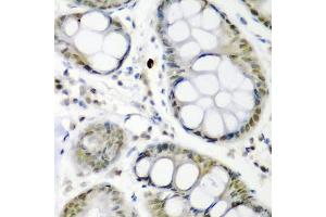 Immunohistochemistry of paraffin-embedded human colon carcinoma using CDC27 antibody (ABIN3015756, ABIN3015757, ABIN1679113 and ABIN6219104) at dilution of 1:200 (40x lens).