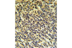 PLA2G6 Antibody IHC analysis in formalin fixed and paraffin embedded testis carcinoma followed by peroxidase conjugation of the secondary antibody and DAB staining. (PLA2G6 anticorps  (AA 551-580))