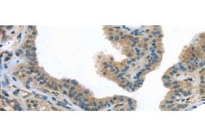 Immunohistochemistry of paraffin-embedded Human thyroid cancer tissue using VLDLR Polyclonal Antibody at dilution 1:40 (VLDLR anticorps)