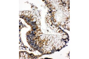 Anti-SOD2 antibody, IHC(P) IHC(P): Human Intestinal Cancer Tissue (SOD2 anticorps  (N-Term))