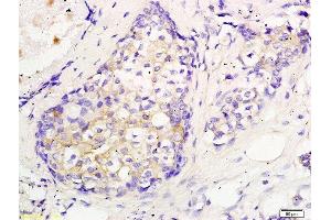 Formalin-fixed and paraffin embedded human breast cancer labeled with Anti CEP55 Polyclonal Antibody, Unconjugated  followed by conjugation to the secondary antibody and DAB staining (CEP55 anticorps  (AA 151-250))