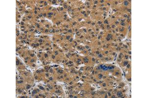 Immunohistochemistry of Human gastric cancer using CLDN2 Polyclonal Antibody at dilution of 1:50 (Claudin 2 anticorps)