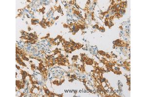 Immunohistochemistry of Human thyroid cancer using IDH3G Polyclonal Antibody at dilution of 1:30 (IDH3G anticorps)