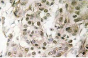 Immunohistochemistry (IHC) analyzes of Nucleophosmin antibody in paraffin-embedded human breast carcinoma tissue. (NPM1 anticorps)