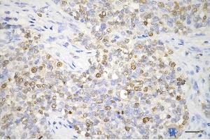 Immunohistochemistry was performed on paraffin-embedded human breast carcinoma using proliferating cell nuclear antigen antibody (ABIN7799915), 1:200). (PCNA anticorps)