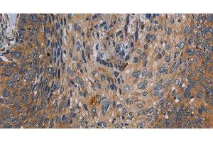 Immunohistochemistry of paraffin-embedded Human cervical cancer tissue using PARP10 Polyclonal Antibody at dilution 1:30