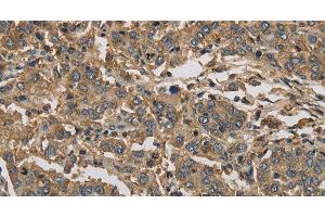 Immunohistochemistry of paraffin-embedded Human liver cancer using KIF22 Polyclonal Antibody at dilution of 1:30