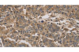Immunohistochemistry of paraffin-embedded Human liver cancer using KIF22 Polyclonal Antibody at dilution of 1:30 (KIF22 anticorps)