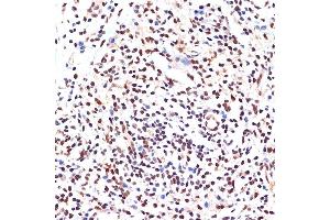 Immunohistochemistry of paraffin-embedded human breast cancer using P Rabbit mAb (ABIN7269156) at dilution of 1:100 (40x lens).