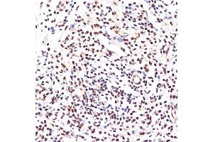 Immunohistochemistry of paraffin-embedded human breast cancer using P Rabbit mAb (ABIN7269156) at dilution of 1:100 (40x lens). (PAX9 anticorps)