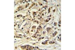 Immunohistochemistry analysis in formalin fixed and paraffin embedded breast carcinoma reacted with METT11D1 Antibody (N-term) followed which was followed by peroxidase conjugated to the secondary antibody and followed by DAB staining. (METTL17 anticorps  (N-Term))