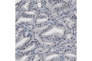 Immunohistochemical staining (Formalin-fixed paraffin-embedded sections) of human prostate cancer with NOP56 monoclonal antibody, clone CL2603  shows strong nucleolar positivity in glandular cells. (NOP56 anticorps)