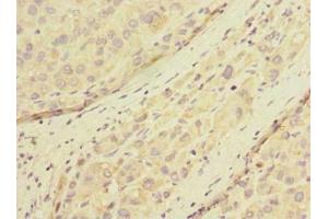 Immunohistochemistry of paraffin-embedded human liver cancer using ABIN7165883 at dilution of 1:100