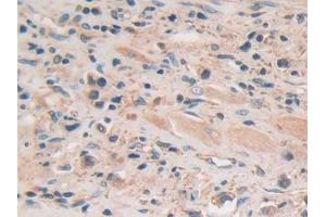 DAB staining on IHC-P; Samples: Human Prostate cancer Tissue (GSAP anticorps  (AA 616-854))