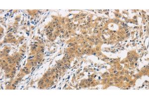 Immunohistochemistry of paraffin-embedded Human gasrtic cancer tissue using ITGB3BP Polyclonal Antibody at dilution 1:50 (ITGB3BP anticorps)
