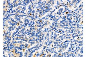ABIN6264984 and ABIN6278347 at 1/100 staining Human kidney cancer by IHC-P. (SENP2 anticorps  (C-Term))