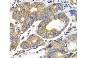 Immunohistochemistry of paraffin-embedded Human gastric cancer using PFKM Polyclonal Antibody at dilution of 1:100 (40x lens). (PFKM anticorps)