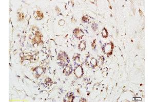 Formalin-fixed and paraffin embedded human breast cancer labeled with Anti-Phospho-Ack1(Tyr284)Polyclonal Antibody, Unconjugated  at 1:200 followed by conjugation to the secondary antibody and DAB staining