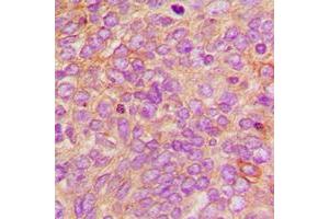 Immunohistochemical analysis of DFF45 staining in human breast cancer formalin fixed paraffin embedded tissue section. (DFFA anticorps  (Center))