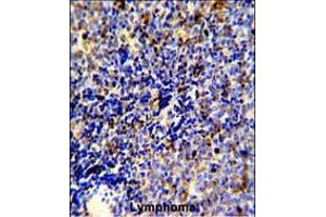 Formalin-fixed and paraffin-embedded human lymphoma reacted with MERTK Antibody, which was peroxidase-conjugated to the secondary antibody, followed by DAB staining. (MERTK anticorps)
