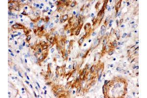 SFRP4 was detected in paraffin-embedded sections of human endometrial carcinoma tissues using rabbit anti SFRP4 Antigen Affinity purified polyclonal antibody at 1 μg/mL.