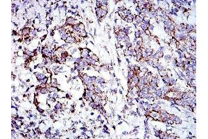 Immunohistochemical analysis of paraffin-embedded stomach cancer tissues using PHB mouse mAb with DAB staining.