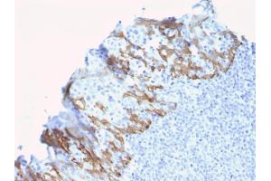 Formalin-fixed, paraffin-embedded human Breast Carcinoma stained with ZNF690 / ZSCAN29 Mouse Monoclonal Antibody (ZSCAN29/2610). (ZSCAN29 anticorps)