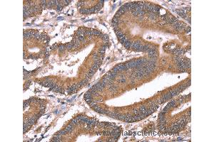 Immunohistochemistry of Human liver cancer using HRG Polyclonal Antibody at dilution of 1:50 (HRG anticorps)