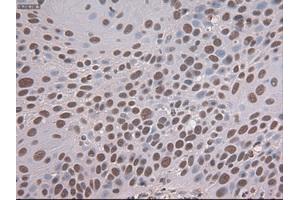 Immunohistochemical staining of paraffin-embedded Adenocarcinoma of colon tissue using anti-NOTCH1mouse monoclonal antibody. (Notch1 anticorps  (AA 2300-2556))