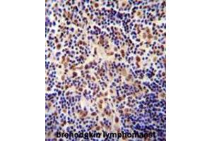 TIGD3 antibody (C-term) immunohistochemistry analysis in formalin fixed and paraffin embedded human hodgkin lymphoma followed by peroxidase conjugation of the secondary antibody and DAB staining. (TIGD3 anticorps  (C-Term))