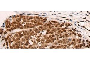 Immunohistochemistry of paraffin-embedded Human thyroid cancer tissue using HGH1 Polyclonal Antibody at dilution of 1:45(x200) (FAM203B anticorps)
