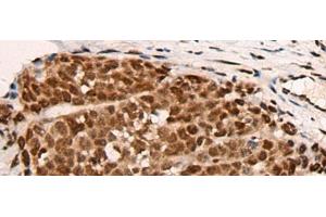 Immunohistochemistry of paraffin-embedded Human thyroid cancer tissue using HGH1 Polyclonal Antibody at dilution of 1:45(x200)