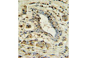 APOL1 Antibody IHC analysis in formalin fixed and paraffin embedded human breast carcinoma followed by peroxidase conjugation of the secondary antibody and DAB staining. (APOL1 anticorps  (AA 137-171))