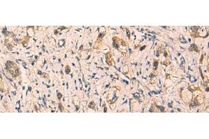 Immunohistochemistry of paraffin-embedded Human liver cancer tissue using CRYM Polyclonal Antibody at dilution of 1:65(x200) (CRYM anticorps)